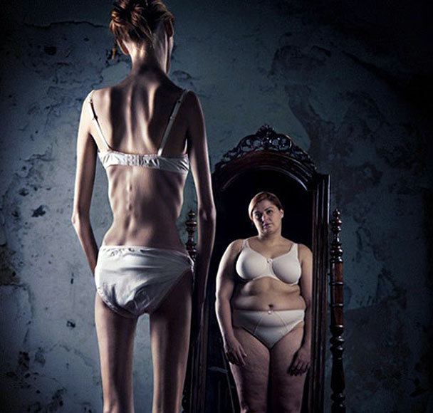 anorexia